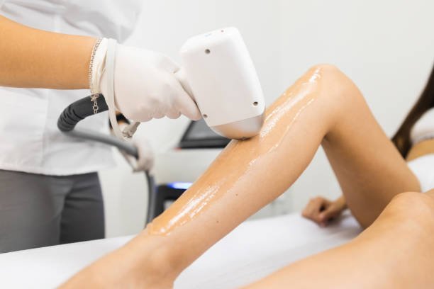 Laser Hair Removal