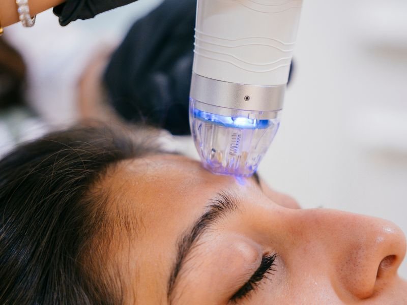 RF Needling
